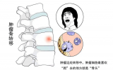 大爷肿瘤接受骨转移核素靶向治疗，用药一周后到处跑